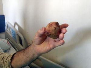 Çaycuma Devlet Hastanesi’nde Başarılı Ameliyatla Sağlığına Kavuştu