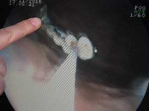 Kaybettiği 5 Dişi Bağırsaklarından Çıktı