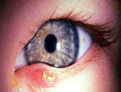 Tekrarlayan arpacık gözü bozuyor