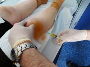 Diz Kireçlenmesinde Prp Tedavisinde Bunlara Dikkat