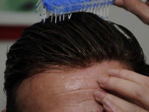 Kellerin Umudu Protez Saç