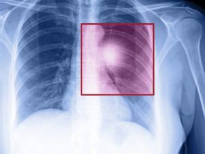 Doç. Dr. Kılıçkap: “Son 5 Yılda Akciğer Kanserine Yönelik Daha Etkili Tedaviler Geliştirildi”