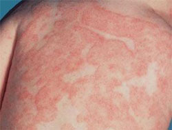 Bu hastalığa dikkat!