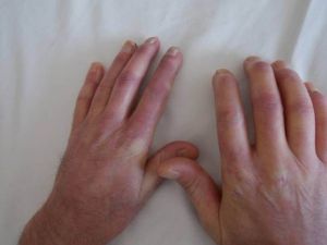 Raynaud Belirtisi Romatizmanın Habercisi Olabilir