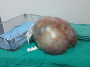 Karın Ağrısıyla Gitti, Futbol Topu Büyüklüğünde Ur Çıktı