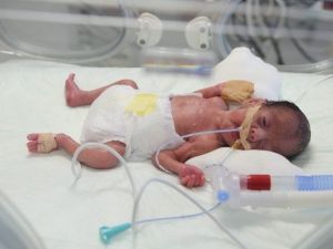 750 Gram Bebeğin Kalbindeki Delik Ameliyatsız Yöntemle Kapatıldı