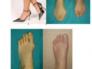 Ayaklarda Ağrıyla Ortaya Çıkan Çarpıklığa Dikkat