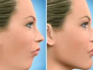 Çene Ucu Estetiğinde Devrim