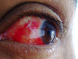 'Kırmızı göz'ün çaresi ne?