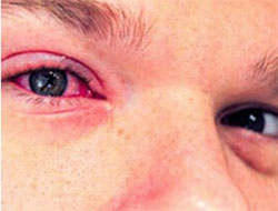 Göz nezlesiyle başa çıkmanın tek yolu...