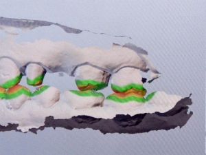 Estetik Dişte Dijital Devir