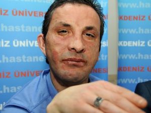 Uğur Acar, Yüz Naklinin 4. Yılında Grip Nedeniyle Hastanede Tedavi Görüyor