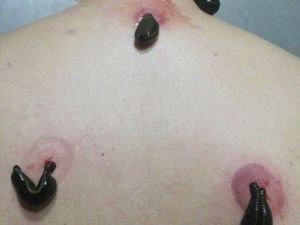 "Sülük Tedavisi Alternatif Tıp Değil"