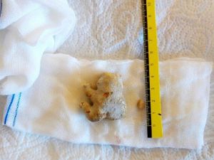 Böbreğinden 4 Buçuk Santimetrelik Taş Çıkartıldı