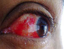 Kırmızı göz alarmı!