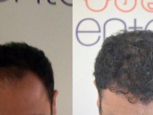 Saç Ekimi Operasyonlarında Şapka Uyarısı