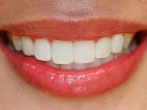 Mükemmel Dişler Özgüven Kazandırıyor