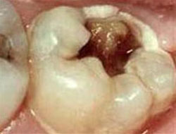 Diş çürüğü artık tarih oluyor!..