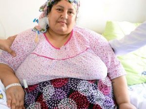 220 Kilo Olan Kadına Başarılı Mide Ameliyatı