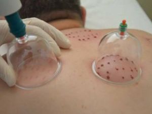 Hacamat Artık Hastanelerde Uygulanıyor