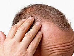 Saç dökülmesinin nedenleri