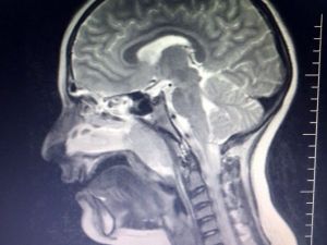 Geniz Eti Çocuklarda Uyku Ve Solunum Zorluğuna Yol Açıyor