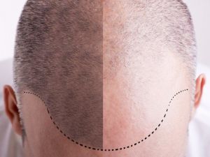 Organik Saç Ekiminin De Taklidi Çıktı