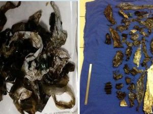 Midesinden 52 Naylon Poşet Parçası Çıkarıldı