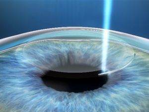 Gözlük Kullanımı 22 Saniyede Tarih Oluyor