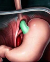 Alkol,sigara ve reflü