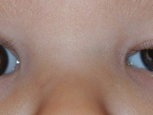 Göz Kapağı Düşüklüğü’ne Dikkat