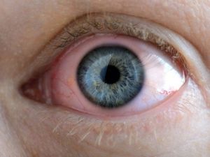 Gözyaşı Kanal Tıkanıklığına Dikkat