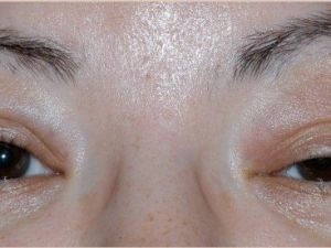 Göz Kapağı Düşüklüğü Görme Kaybına Neden Olabiliyor