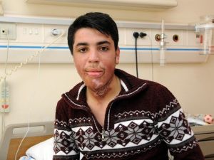 Bombalı Saldırıda Boynu Yanan Genç, Antalya’da Sağlığına Kavuştu