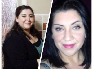 Obezitede Kalıcı Tedavinin Yöntemi Gastrikby-pass