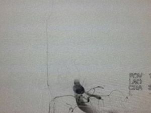 Her Altı Saniyede Bir Kişi İnme Geçiriyor