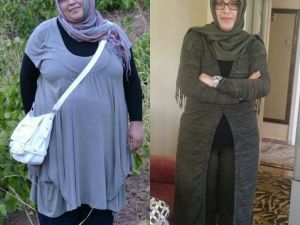 Tüp Mide Ameliyatı İle Hayatları Değişti