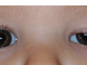 Çocuklarda Göz Kapağı Düşüklüğü Önemsenmeli!