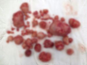 Hastanın Rahminden 81 Adet Miyom Çıktı