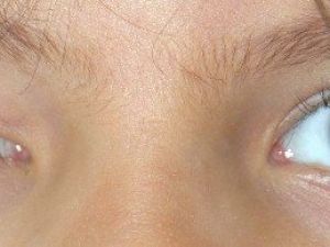 Göz Kapağı Düşüklüğü Deyip Geçmeyin