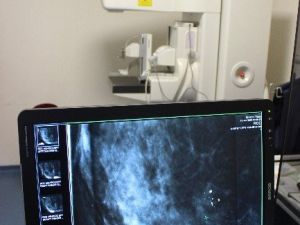 Bu Cihazla Meme Kanseri Önceden Teşhis Edilecek