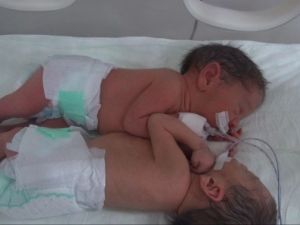 Siyam İkizleri Başarılı Ameliyatla Ayrıldı