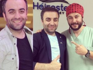 Saç Ekiminde Tepe Kısma Dikkat