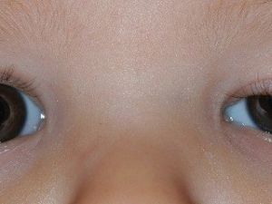 Çocuklarda Göz Kapağı Düşüklüğü Önemsenmeli