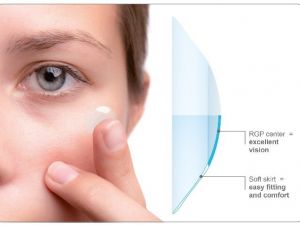 Keratokonus Tedavisinde Kontakt Lens Kullanımı