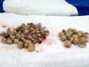 Bu Taşlar Doktoru Da Şaşırttı