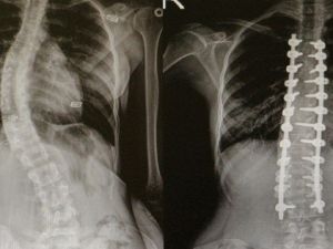 Omurga Eğriliği Olanlar Omü’de Şifa Buluyor