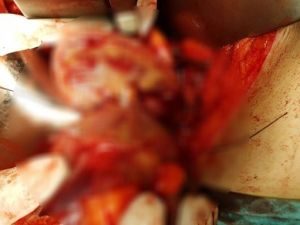 Böbreğinden 550 Gramlık Tümör Çıkarıldı