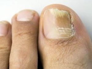 Tırnak Mantarından Lazerle Kurtulmak Mümkün