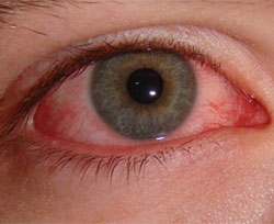 Gözünüz kanlanıyorsa aman dikkat!